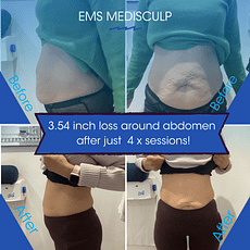 image of woman after taking EMS Medisculp to burn fat and build muscle