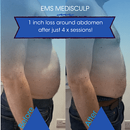 before and after pictures of man after taking a course of 4 treatments of EMS Medisculp to build muscle and burn fat
