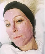cryotherapy-algae-facial