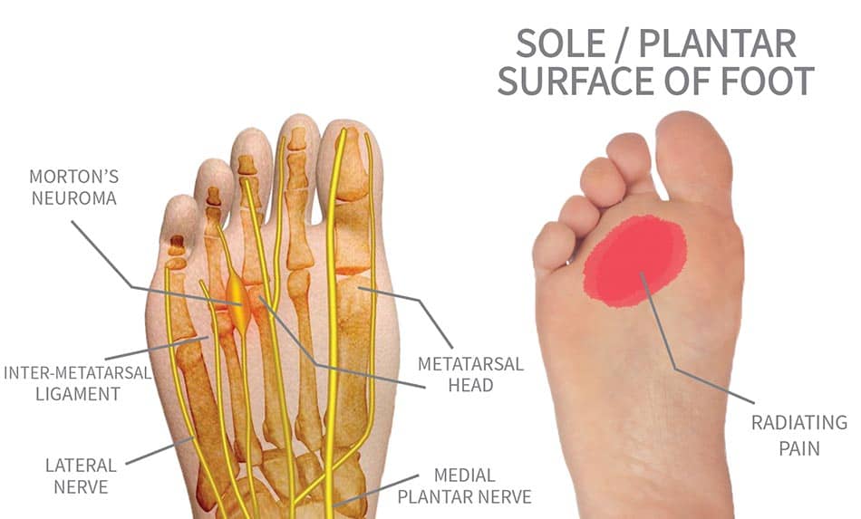 Is pain in the ball of your foot Mortons Neuroma?