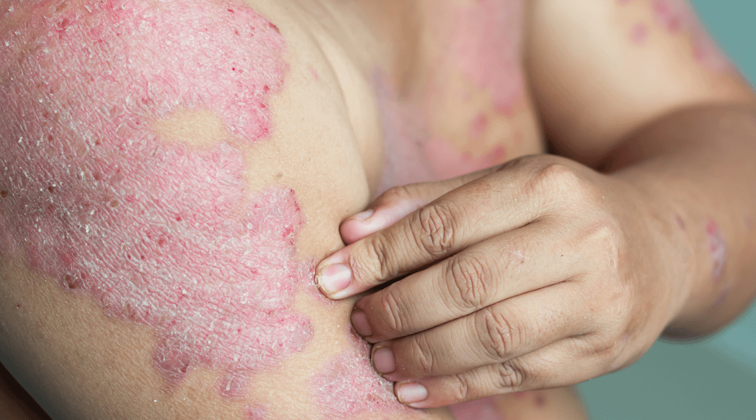 How cryotherapy eases symptoms of eczema and topical steroid withdrawal